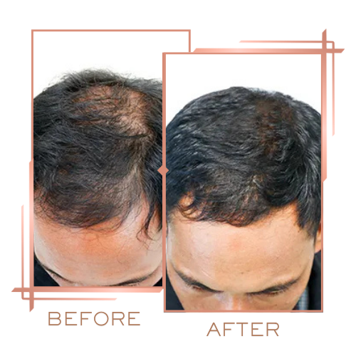 Patient before and after hair treatment for female pattern thinning