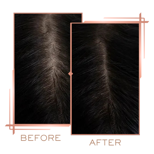 Patient before and after hair treatment for receding hairline