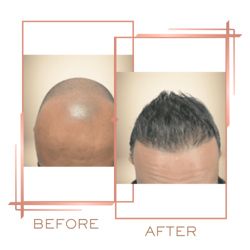 Before and after for male hair density