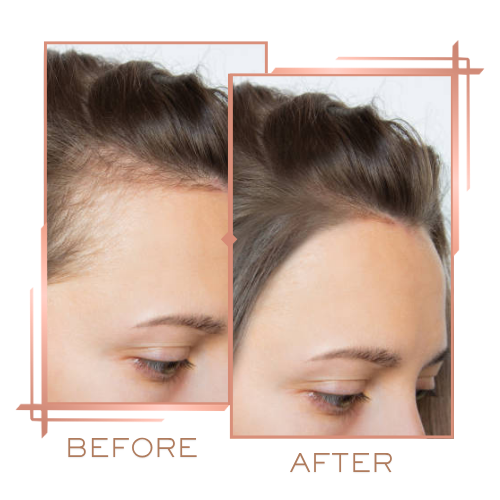 Before and after for male hair density