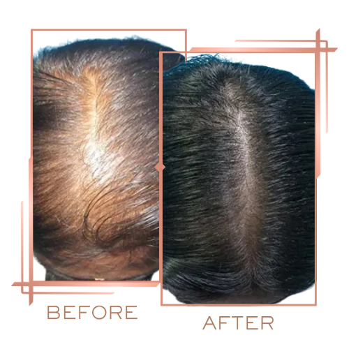 Before and after for male hair density