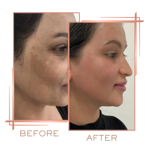 Patient before and after microneedling for skin rejuvenation and glow