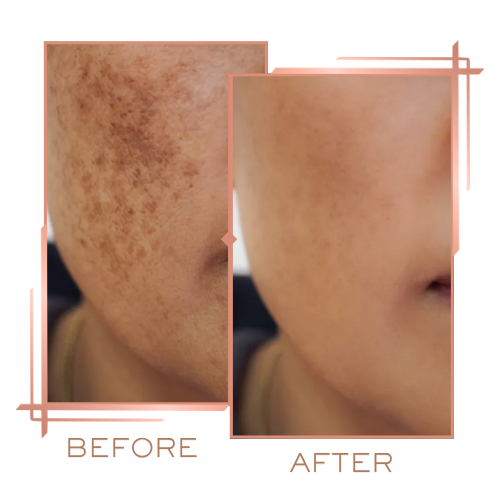 Before and after microneedling for pigmentation