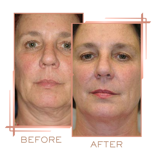Before and after microneedling for pigmentation