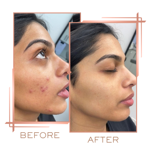 Patient before and after melasma treatment on forehead