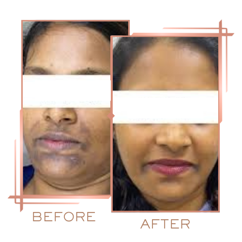Patient before and after melasma treatment on forehead