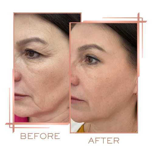 Before and after melasma therapy results