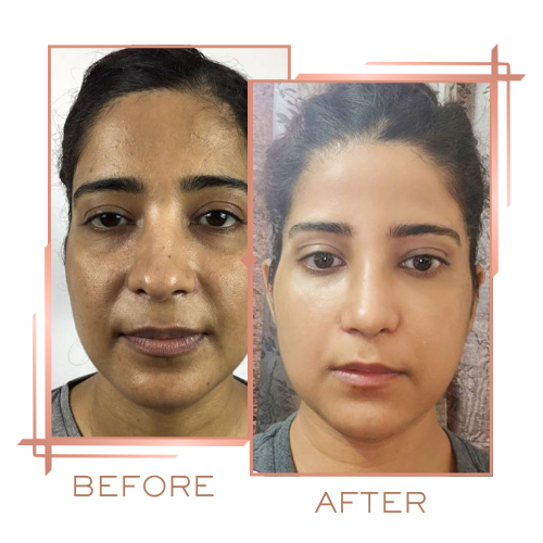 Before and after showing improved skin clarity after melasma treatment