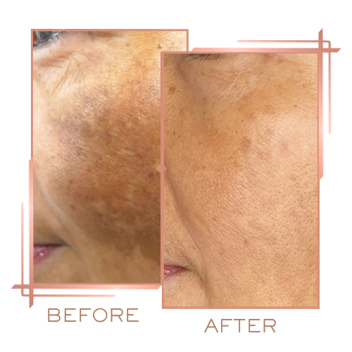 Patient before and after melasma treatment on forehead